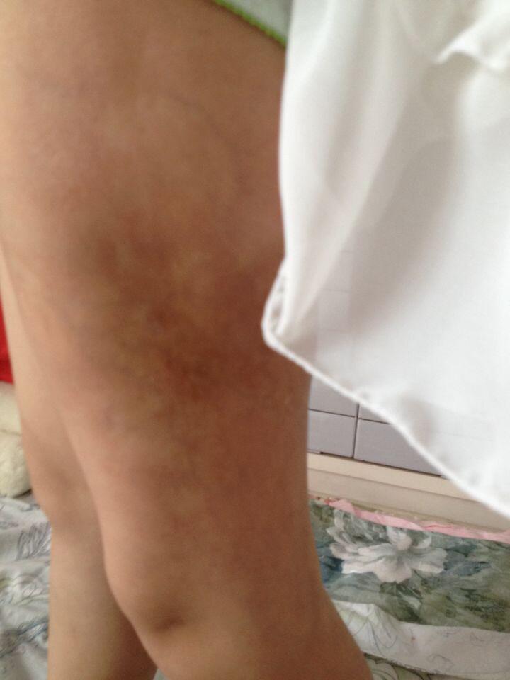  霄霄3岁患病 腿上有着明显的疤痕