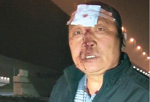 郑州：男子夜骑电动遇上无盖窨井 摔得血肉模糊