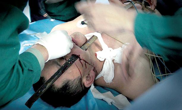 男子一步踏空摔倒 80厘米长扁铁扎穿面部(图)